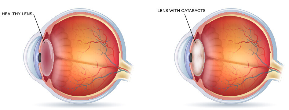 Cataract diagram