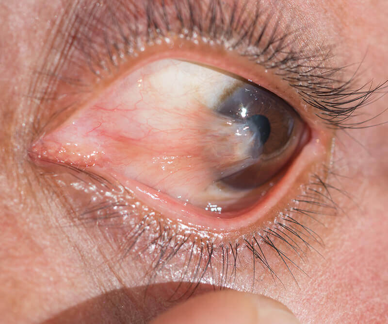 Pterygium of the eye