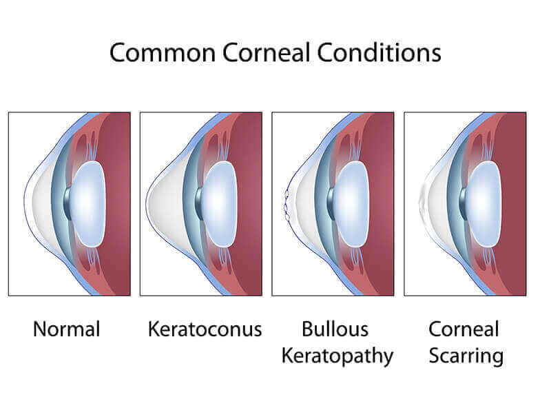 Common corneal conditions chart