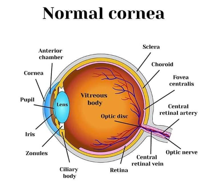 Keratoconus diagram