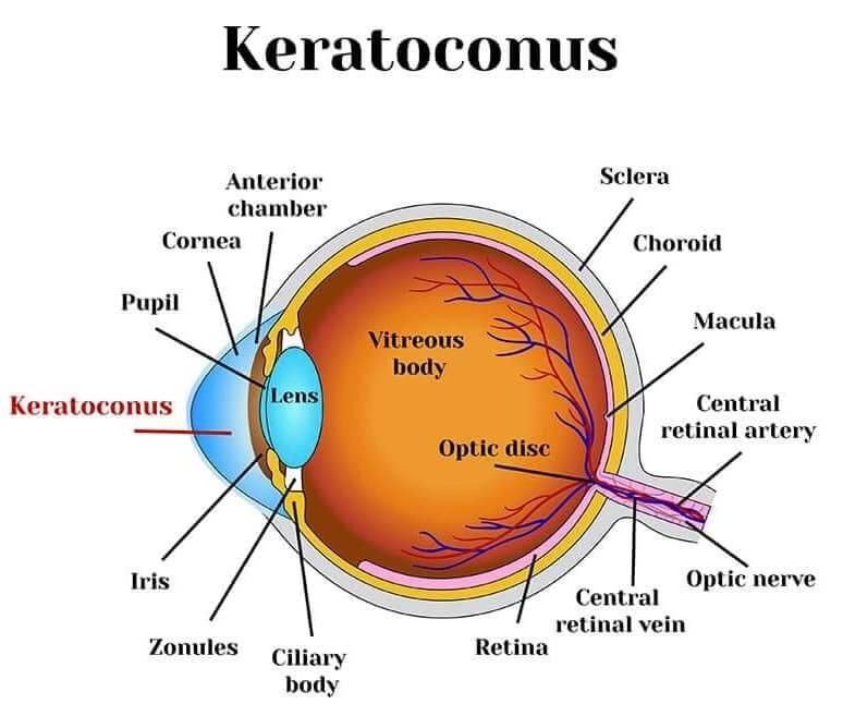Keratoconus treatment
